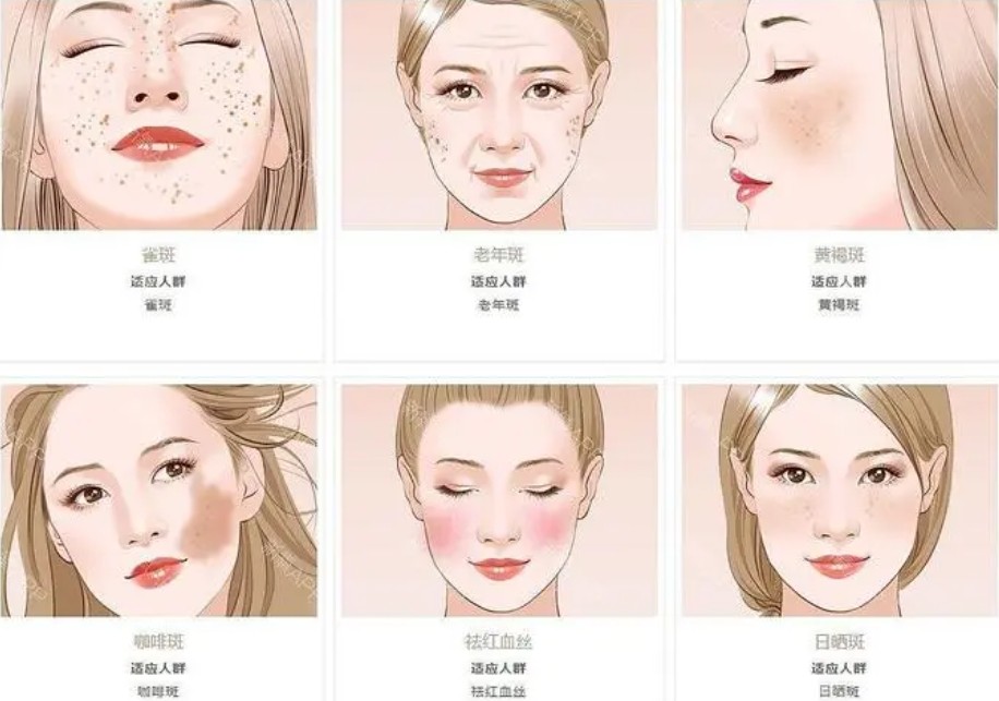 滤光片 激光美容适宜人群