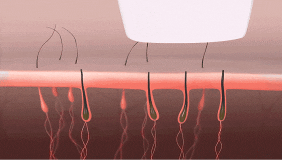 光子美容仪脱毛效果图 光子美容仪脱毛效果图