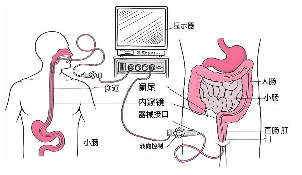 滤光片 肠胃镜演示图